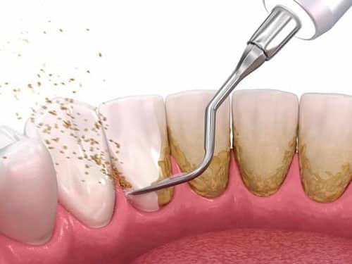 Địa Chỉ Phòng Khám Nha Khoa Cạo Vôi Răng Quận Gò Vấp