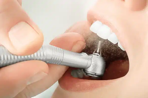 Tác Dụng Và Tác Hại Của Việc Lấy Cao Răng 3 Tác dụng và tác hại của việc lấy cao răng