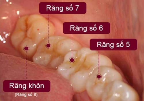 Chi phí nhổ răng khôn