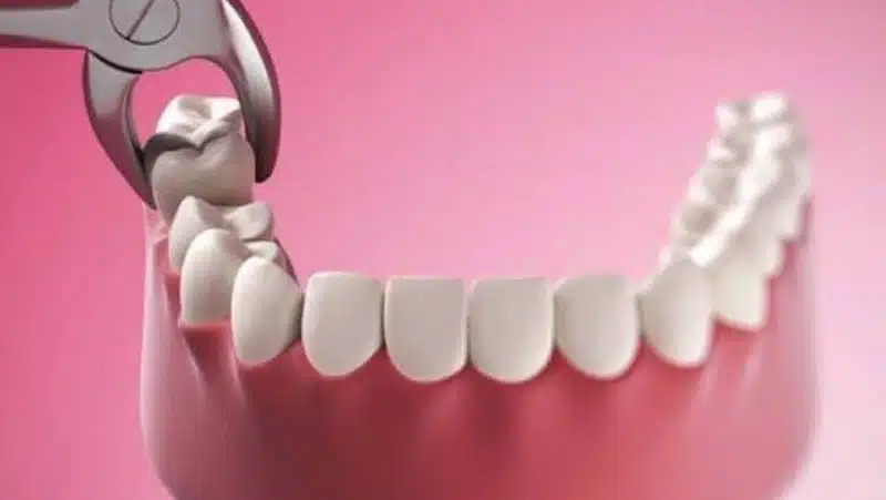 Nhổ răng khôn giá rẻ: có nên lựa chọn?