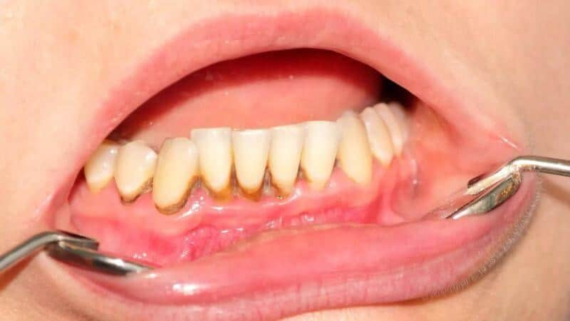 Địa Chỉ Phòng Khám Nha Khoa Cạo Vôi Răng Quận Bình Thạnh