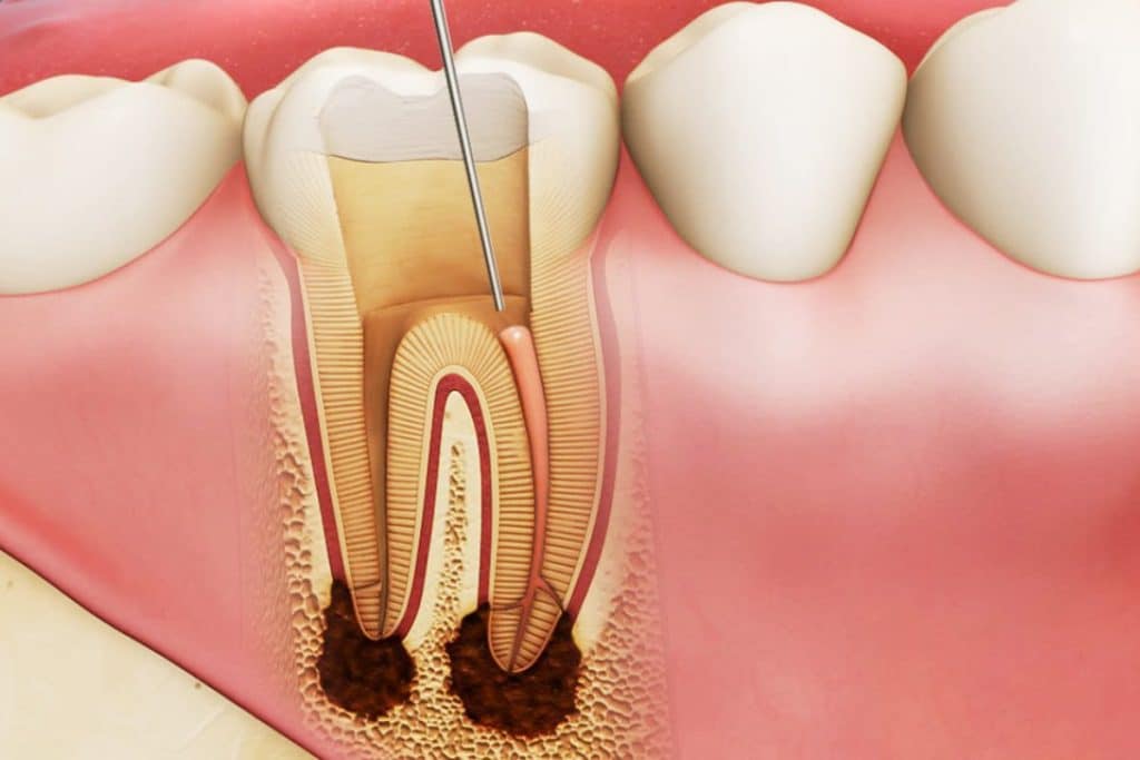 Điều trị tủy răng mất bao lâu?