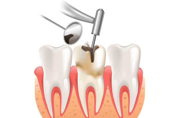 Điều trị tủy răng có đau không?