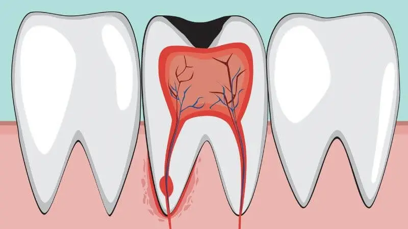 Điều trị tuỷ răng bao lâu Tìm hiểu quy trình và thời gian