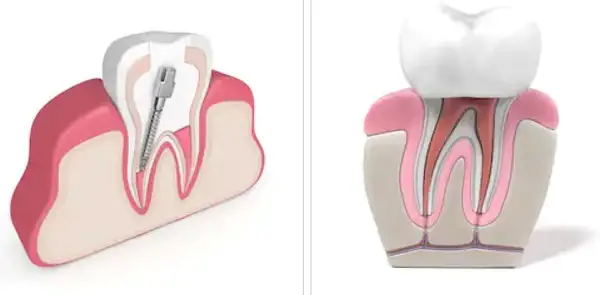 Điều Trị Tủy Răng Bao Nhiêu Tiền? 1 Điều Trị Tủy Răng Bao Nhiêu Tiền?
