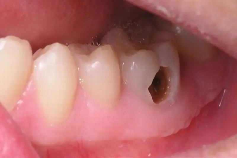 Điều Trị Tuỷ Răng Xong Có Đau Không? Điều Trị Tuỷ Răng Xong Có Đau Không?