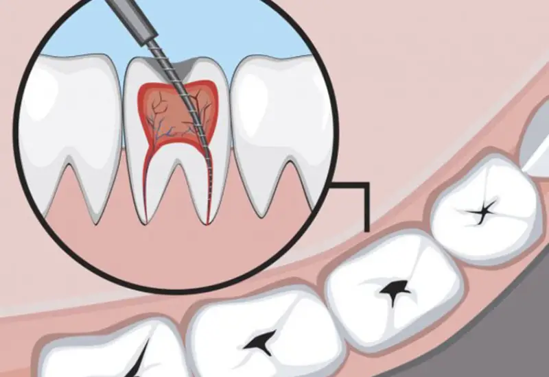 Lấy Tủy Răng và Bọc Răng - Quy Trình, Lợi Ích và Chi Phí 1 Lấy tủy răng và bọc răng Quy trình, lợi ích và phương pháp chăm sóc