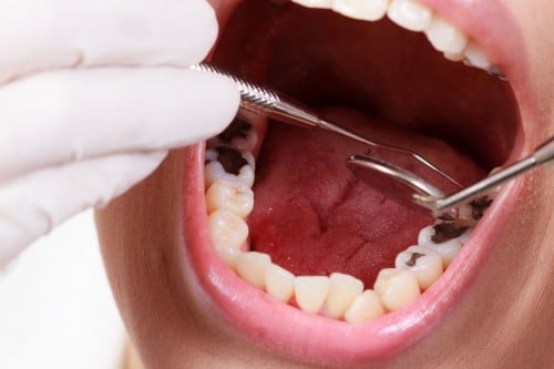 điều trị tuỷ răng hàm