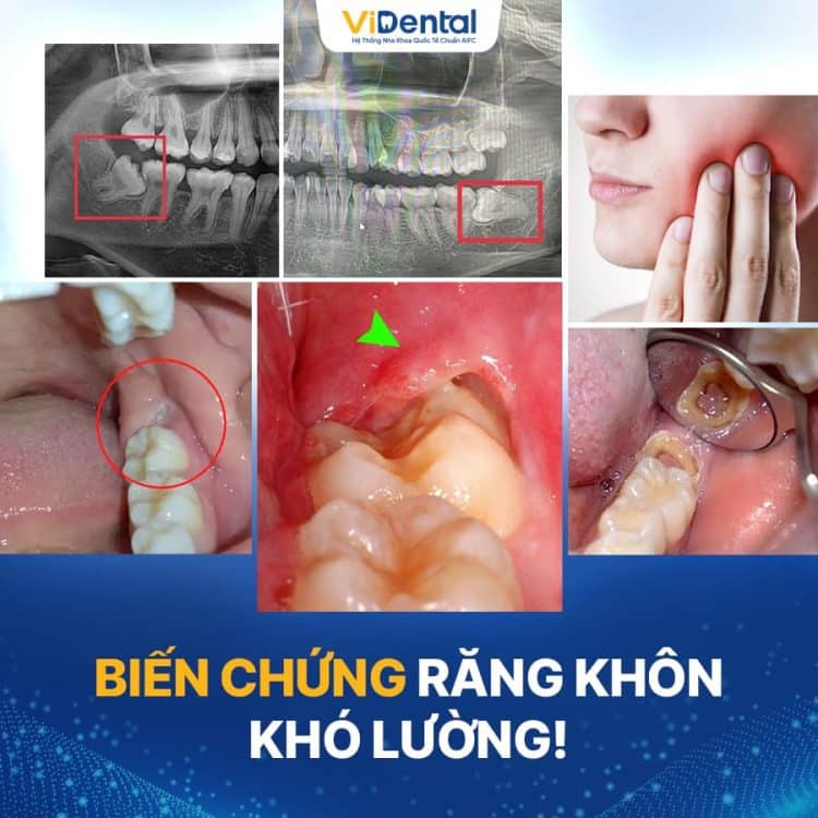 nho-rang-khon-vidental-9-750x750
