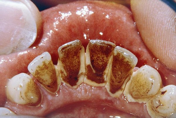 Những nguyên nhân thực sự khiến răng bị thưa