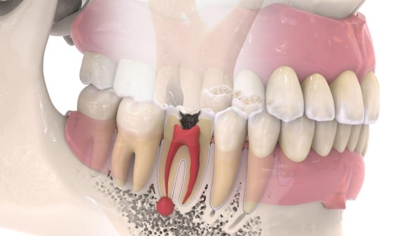 Điều Trị Tủy Răng Tại Bình Thạnh
