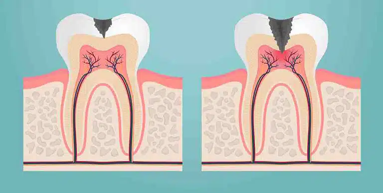 điều trị tuỷ răng hàm