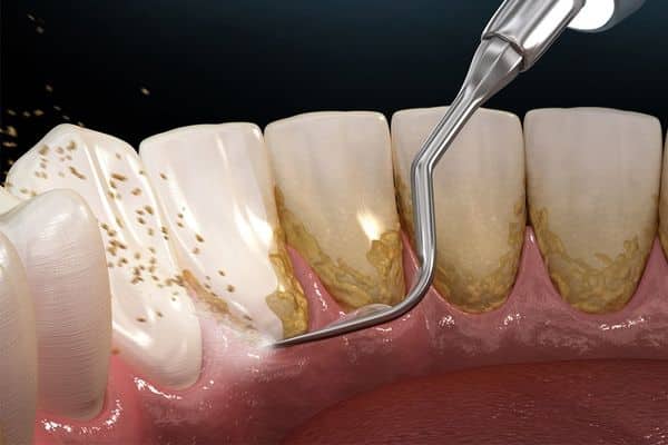 Lấy cao răng với chi phí thấp có làm trắng răng không?