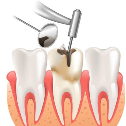 Điều Trị Tủy Răng Phú Nhuận