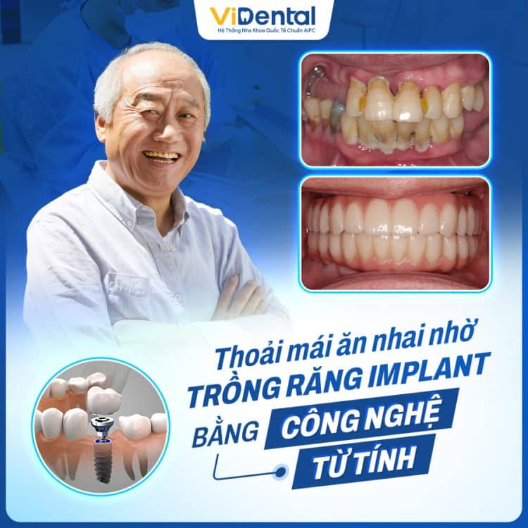 Banner Dịch Vụ Trồng Răng Implant Tại Nha Khoa Guva Dental 2