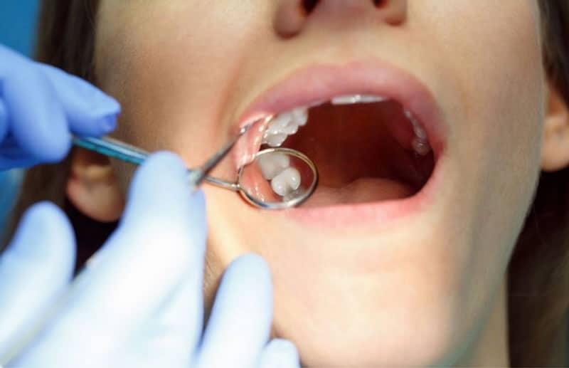 Nhổ Răng Khôn Giá Rẻ Có An Toàn Không? Những Điều Cần Lưu Ý Khi Lựa Chọn