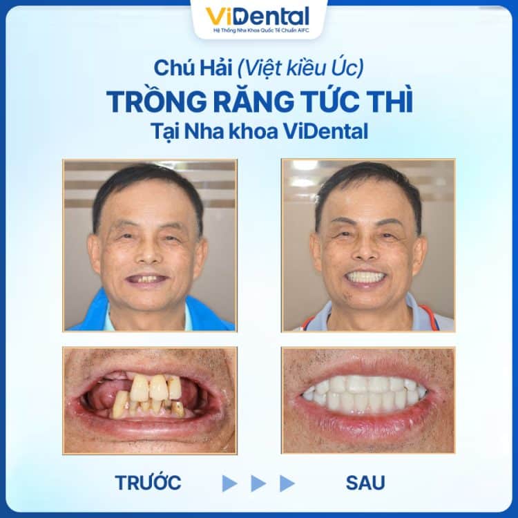 Phản hồi khách hàng trồng răng Implant 1