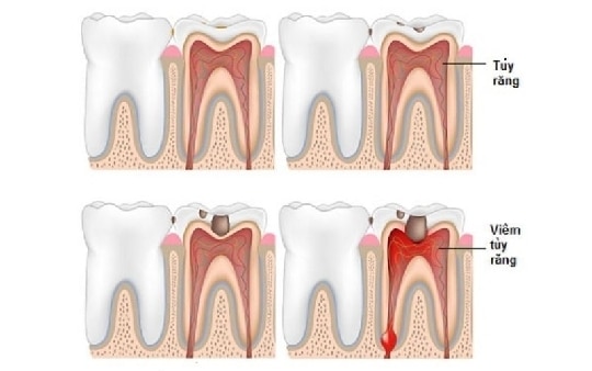 cách giảm đau tuỷ răng