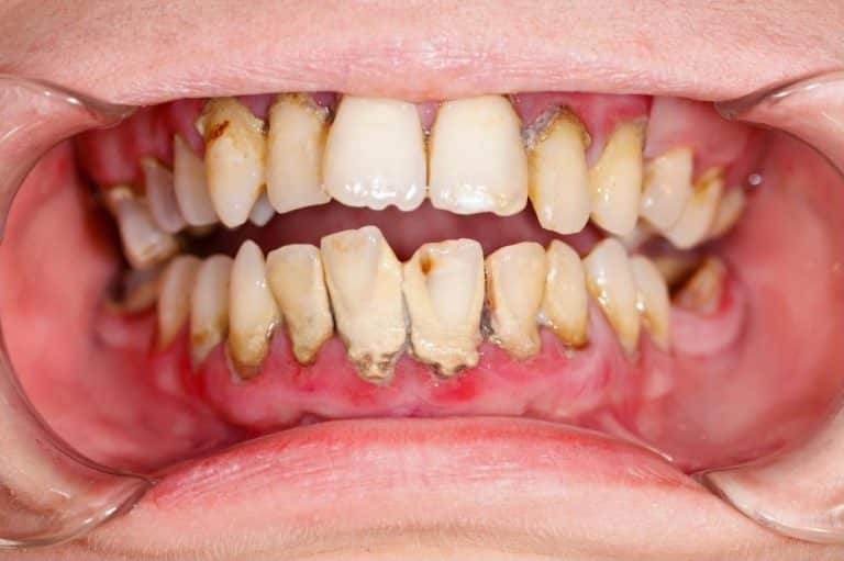 Lấy Cao Răng Mất Bao Lâu?