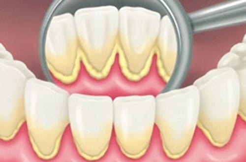 Chi phí cho 1 lần lấy cao răng