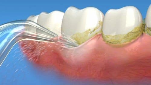 Lấy cao răng với chi phí thấp có làm trắng răng không?
