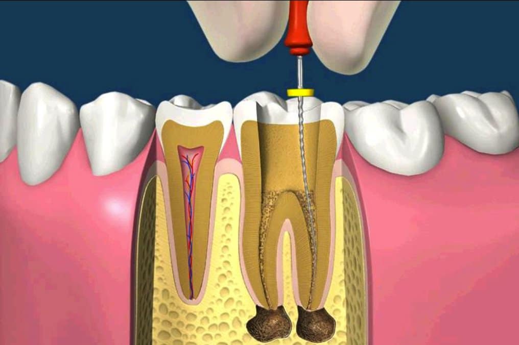 Điều Trị Tủy Răng Trẻ Em