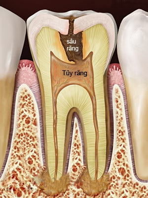 Điều Trị Tủy Răng Phú Nhuận