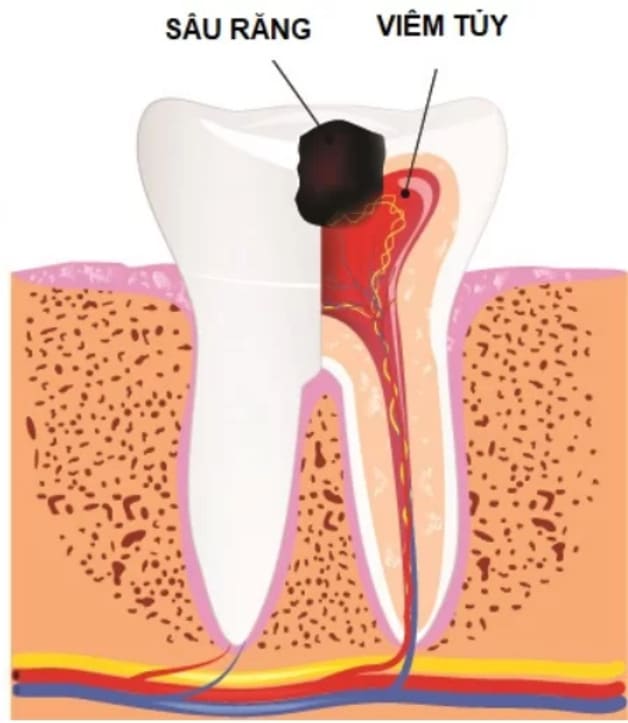 Điều Trị Tủy Răng Trẻ Em