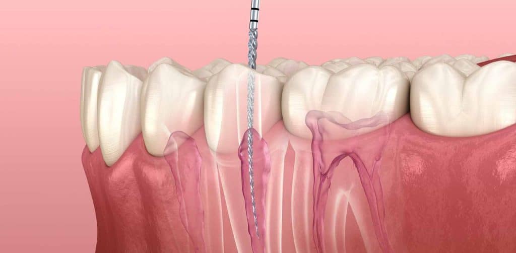 cách giảm đau tuỷ răng