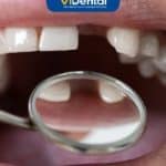 Mất 1 Răng Cửa