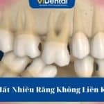 Mất Nhiều Răng Không Liền Kề