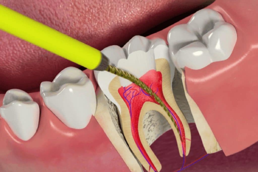 Điều Trị Tủy Răng HCM