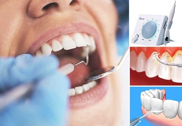 Cách tìm phòng khám lấy cao răng với giá tốt và uy tín
