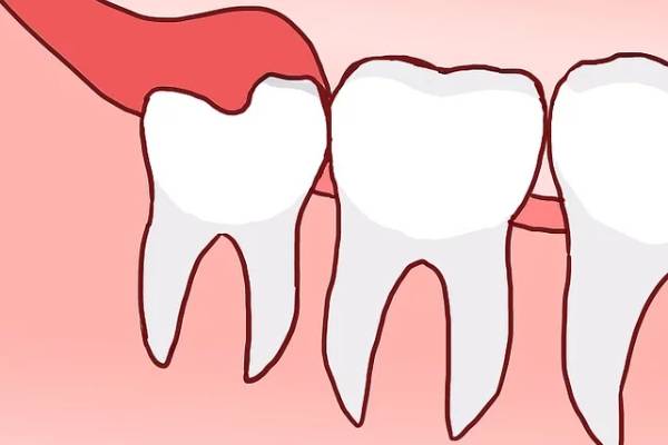 Có nên nhổ răng khôn mọc thẳng không