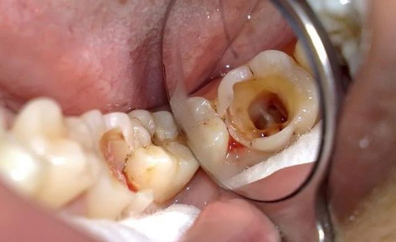 Điều Trị Tủy Răng Trẻ Em