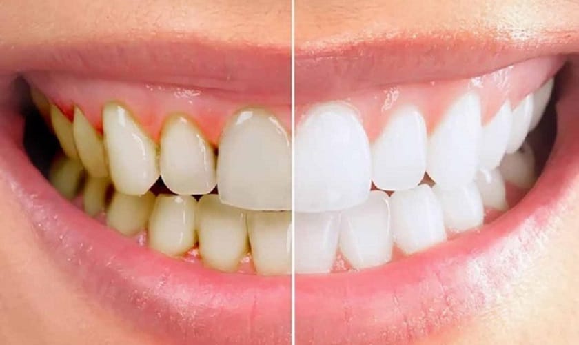 Lấy Cao Răng Mất Bao Lâu?