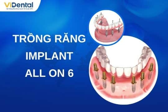trong rang implant all on 6 540x360 1
