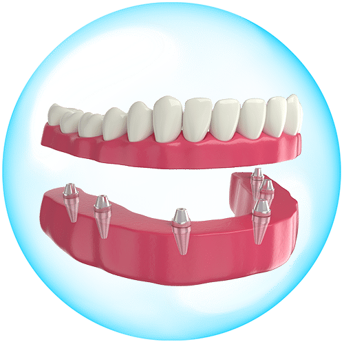 trong-rang-implant-toan-ham