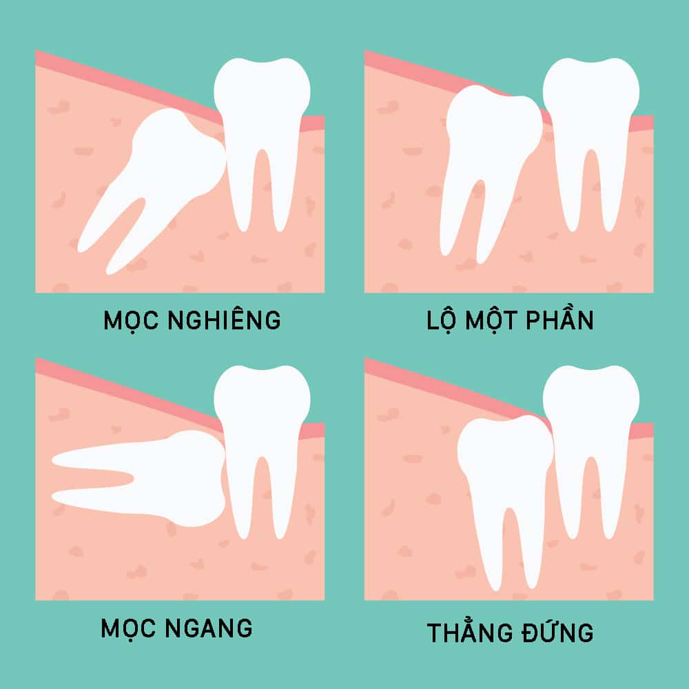 Chi Phí Nhổ Răng Khôn