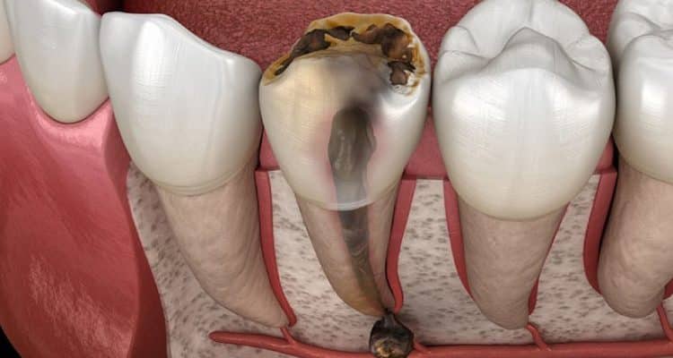 Điều Trị Tủy Răng Trẻ Em