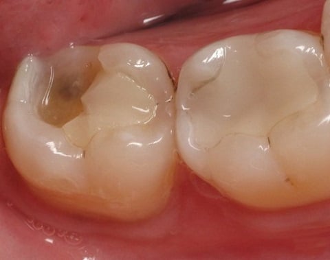 cách giảm đau tuỷ răng