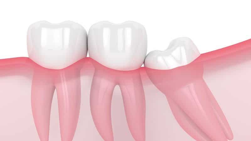 biến chứng nhổ răng khôn hàm dưới
