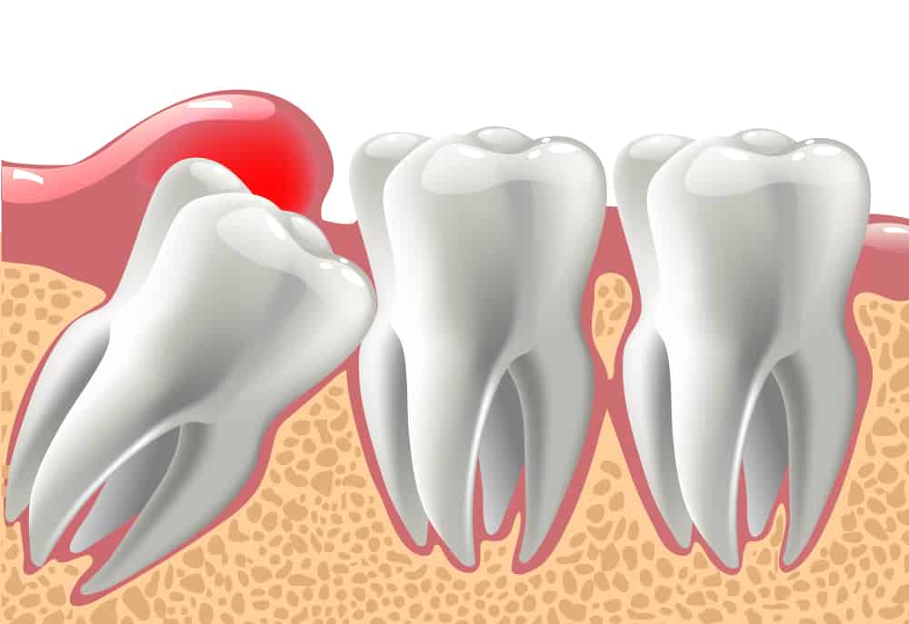 Khi nào nên nhổ bỏ răng khôn?