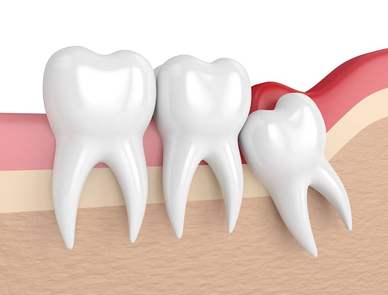 Răng khôn để lâu có sao không? Những tác động lâu dài đến sức khỏe răng miệng.