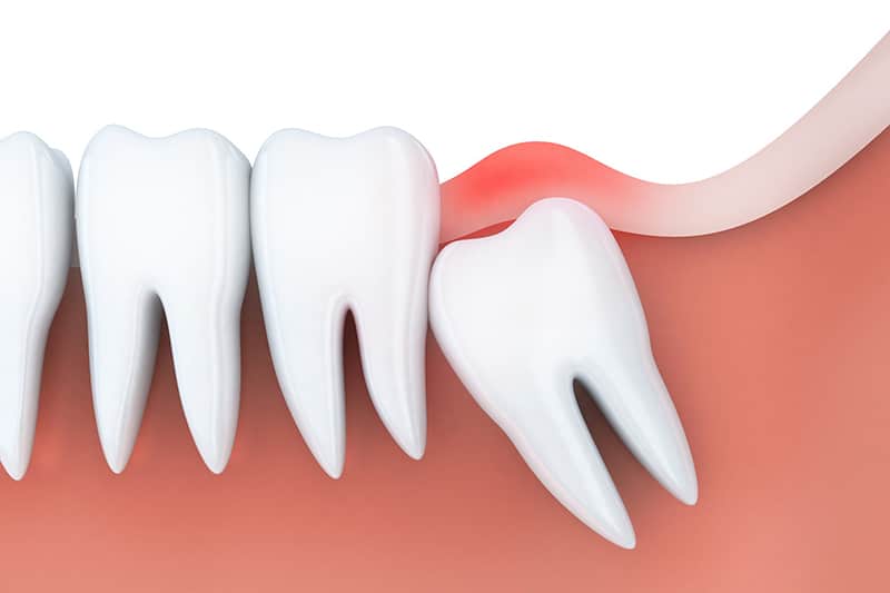 Tại sao nên chọn phòng khám chuyên nghiệp để nhổ răng khôn ở TP.HCM?