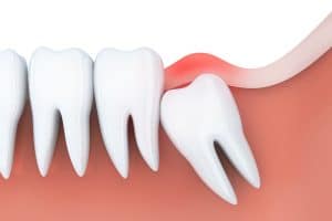 biến chứng thường gặp khi nhổ răng khôn