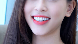 lấy cao răng bằng laser