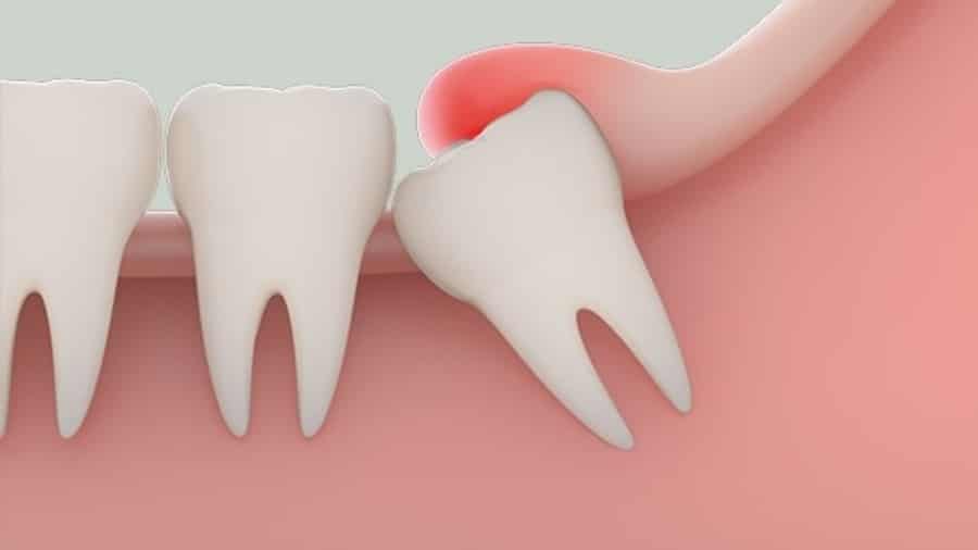Khi Nào Cần Nhổ Răng Khôn?