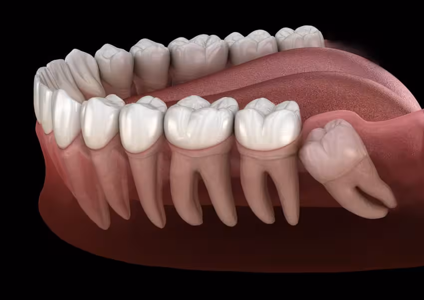 Nhổ răng số 8 chi phí bao nhiêu? Những yếu tố quyết định đến giá cả.