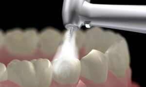 lấy cao răng bằng máy siêu âm